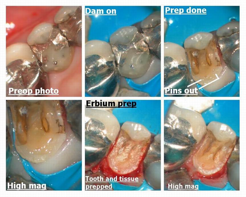 Resize of Premolar recontouring pg 1.jpg